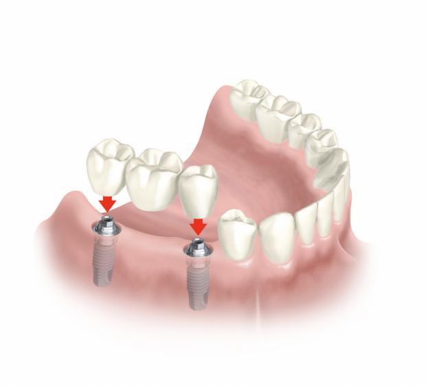 Implantodontia - Oral Arte Odontologia