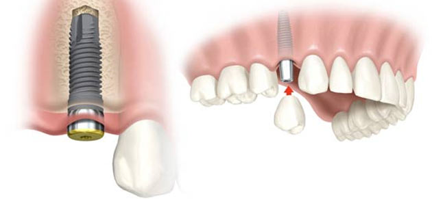 Implantodontia - Oral Arte Odontologia